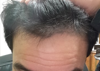 2016년1월11일 약물복용120여일후