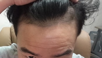 복용 9개월후 6월13일 사진