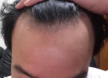 2015년9월21일 약물복용 일주일후