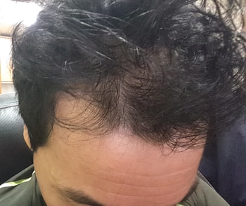 2015년10월17일 쉐딩시작(미녹시딜도포중 사진)