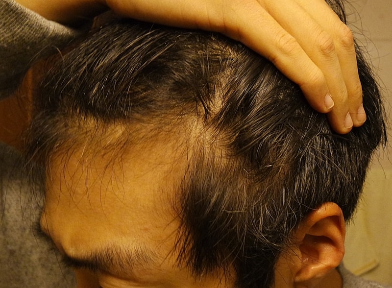 (혐주의)헤어그로정(피나스테리드) + 나녹시딜 5% 17일차 (현재는 30일차)