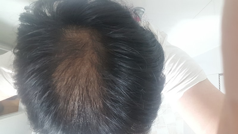 프로스카3일째네요(미녹시딜 바를예정)