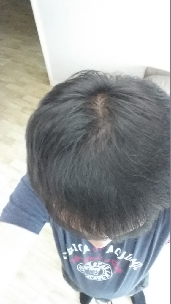 2015년 5월(약복용 5개월차)