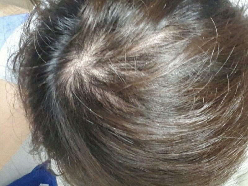 피나스테리드 8개월차 어때보이나요!?