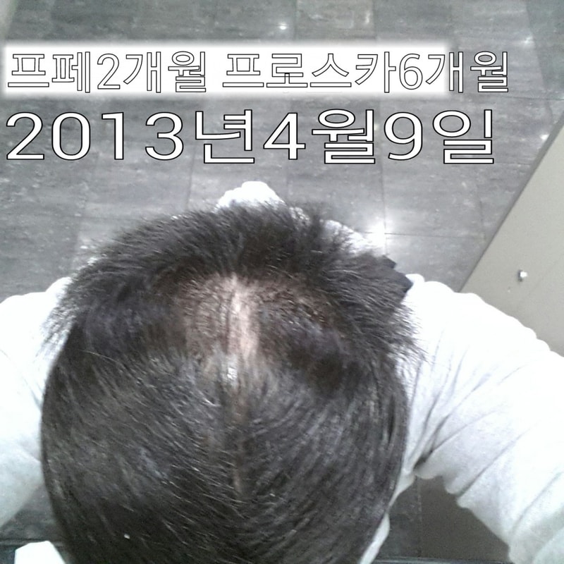 Propecia 2个月，Prosca 12个月后期。