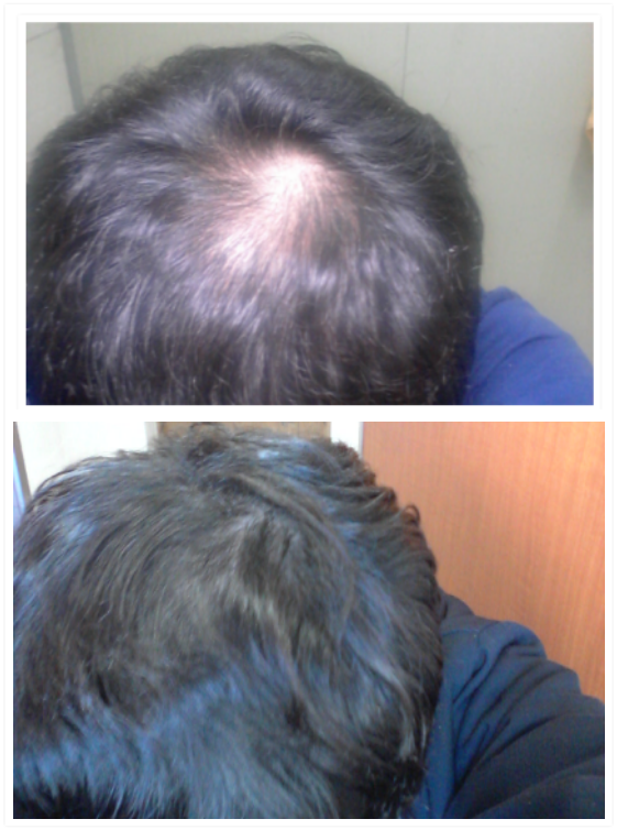 Propecia服用9个月。