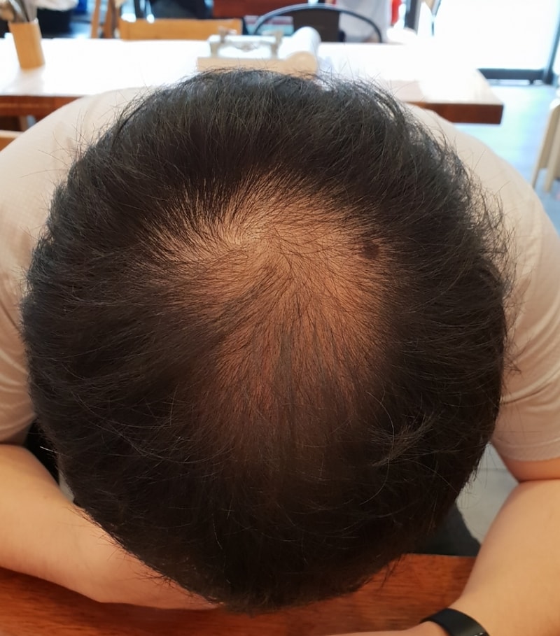 Monápecia (Profecia capi drug) 40 days of eating and changing difference