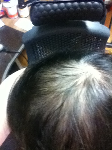 干细胞注射+Minoxidil +Propecia各经过后期