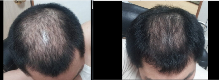 (좌)시작전,(우)85일째