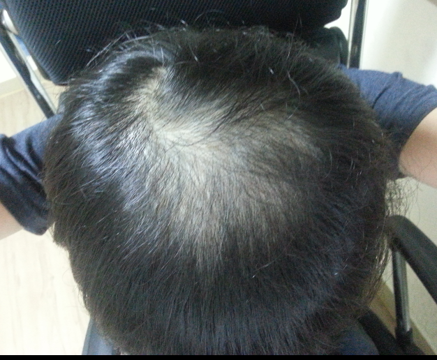 조합약73일차 경과 후기입니다 ^^