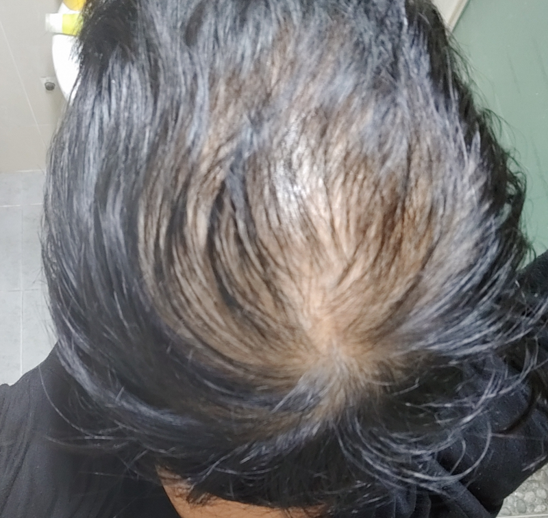 피나온정 + 미녹시딜 (반알) - 6개월 처방