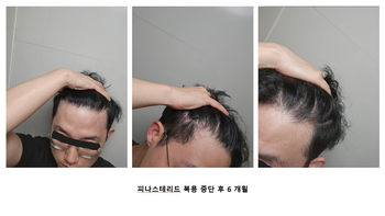 복용 중단 후 6개월차, 샴푸 방법과 식사량증가로 일부 유지 된 듯 함. 눈썹 탈모가 개선됨.