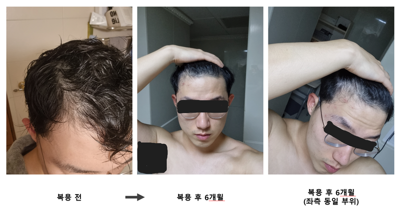 피나 카피약 6개월 복용, 6개월 중단.