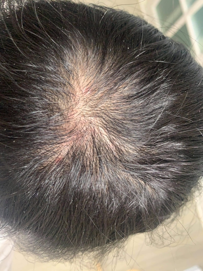 미녹시딜 좋은거같아요