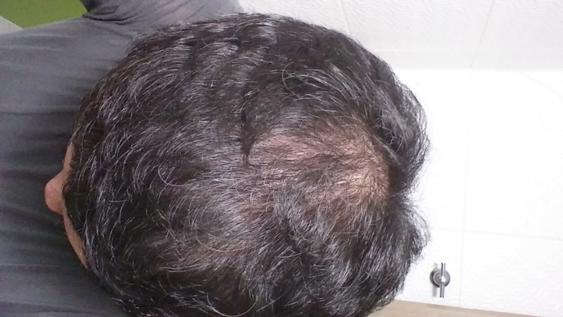 프로스카 먹은지 8개월 정도 됐는데 차이가 있나요??