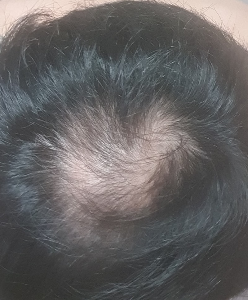 6개월 피나복용