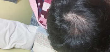 피나 6개월