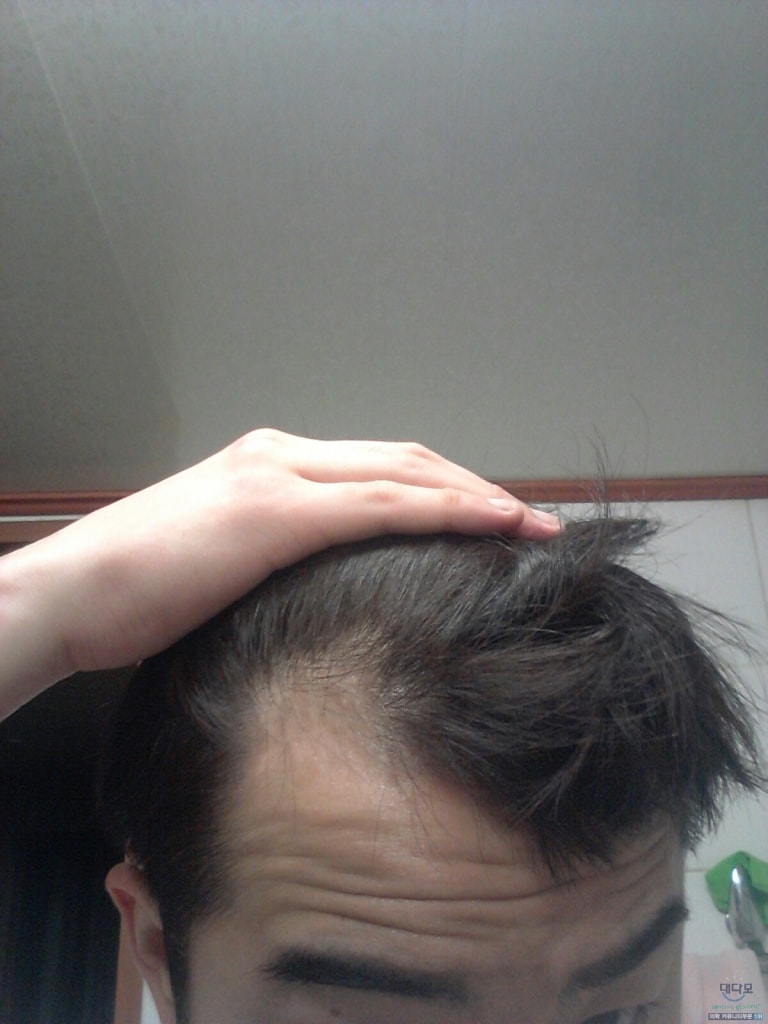 M字脱发abodat+myloxil 3个月后半期服用前后照片比较判断。