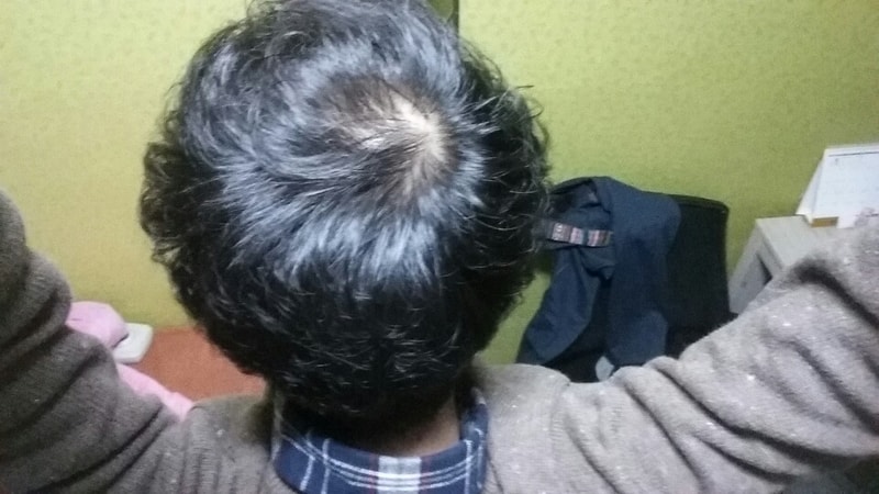 아주 오랜만에 글을 남기는거 같습니다. 피나 스테이드 2년 4개월? 후기입니다.