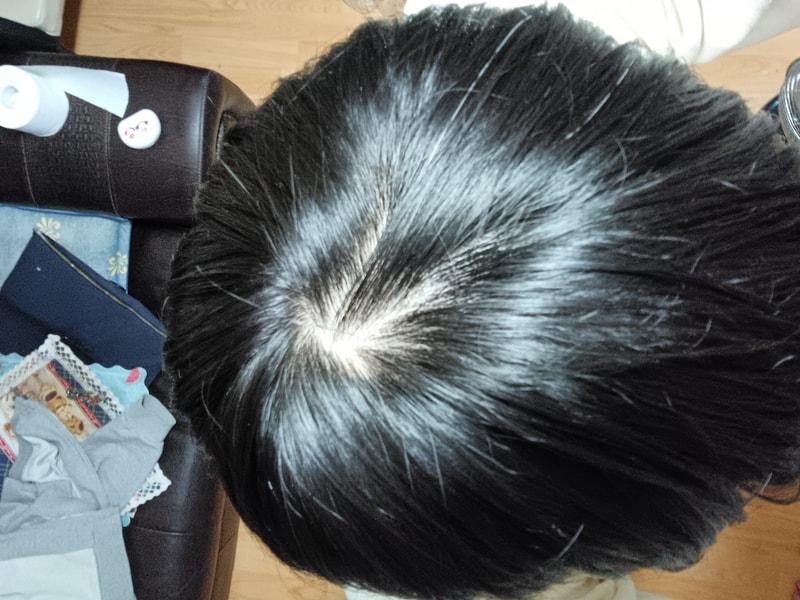 Hair loss (heavy dermatitis)