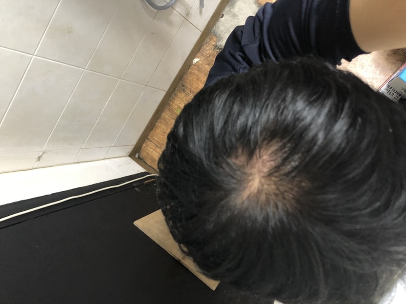 2018년 8월 탈모의 심각성 느낌