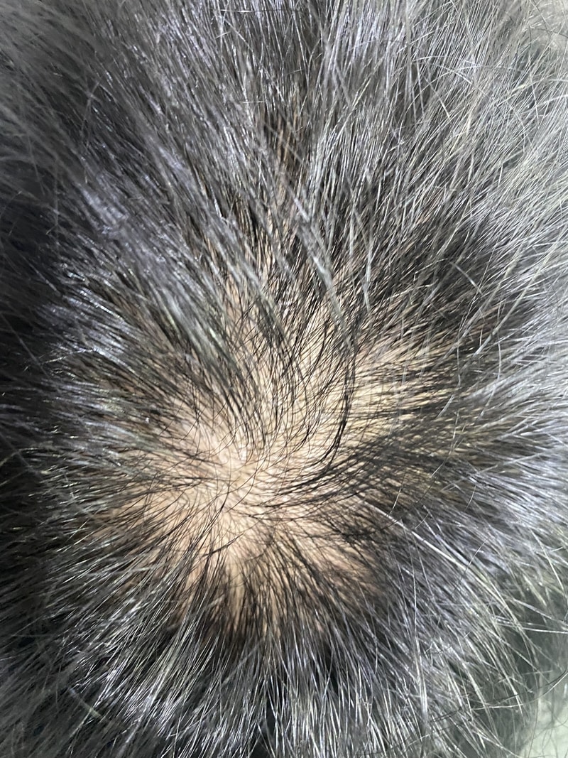 Propecia, Day 1 of taking Rogainform