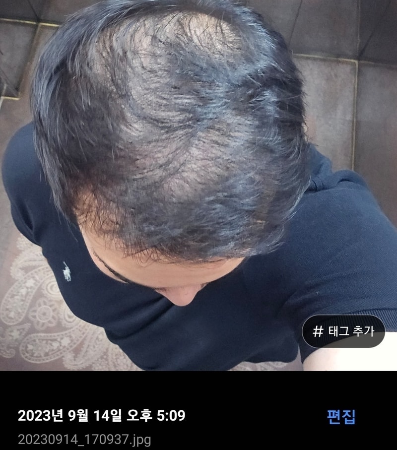 4개월차.  피나+먹는미녹시딜+바르는 미녹시딜 후기