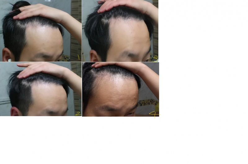 Prosca 1年5天+Minoxidil 7个月m后记！