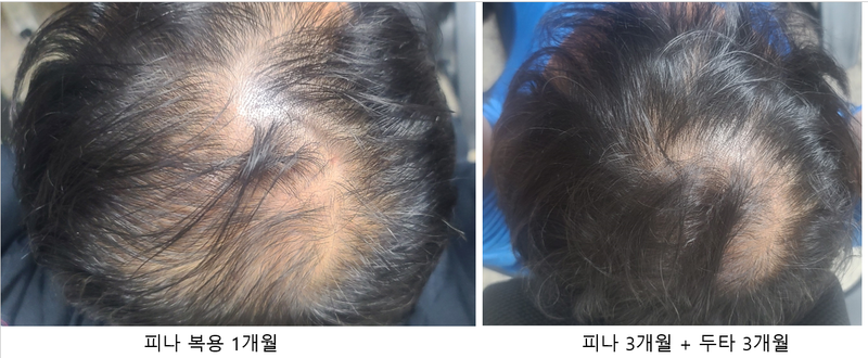 50대 탈모약 6개월 차..