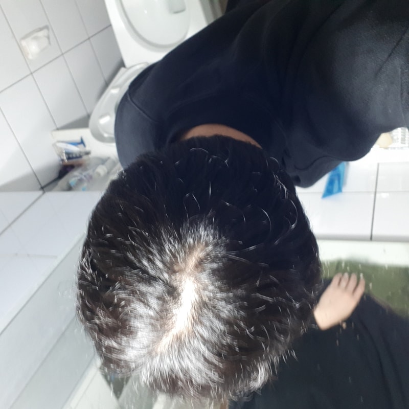 I'm taking Propecia for 1 year and 3 months and Avodat for 4 months.