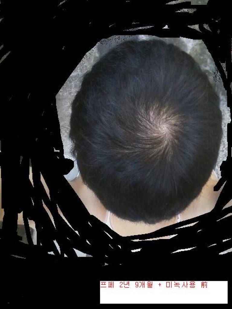 头顶脱发。未锈用第9周后期 有照片。