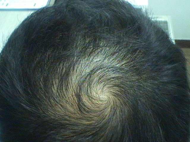 정수리 남성형 탈모 (프페 22개월 후기)