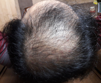 약 처방 152일 후