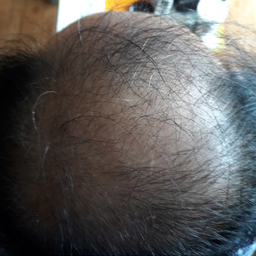 Pina, after prescribing minoxidil