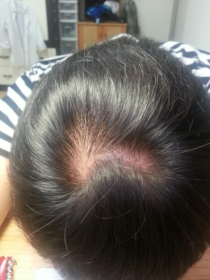 뒤통수탈모 1년 8개월 프페 복용