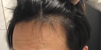 오늘.어두운 빛 (실제로는 저거보다 더 두피가 들여다보입니다.)
