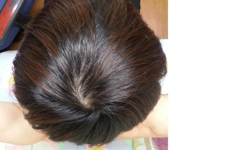 프카+프페 6개월 후기입니다