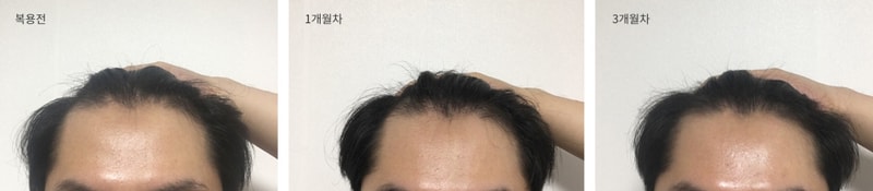 Propecia三个月后期