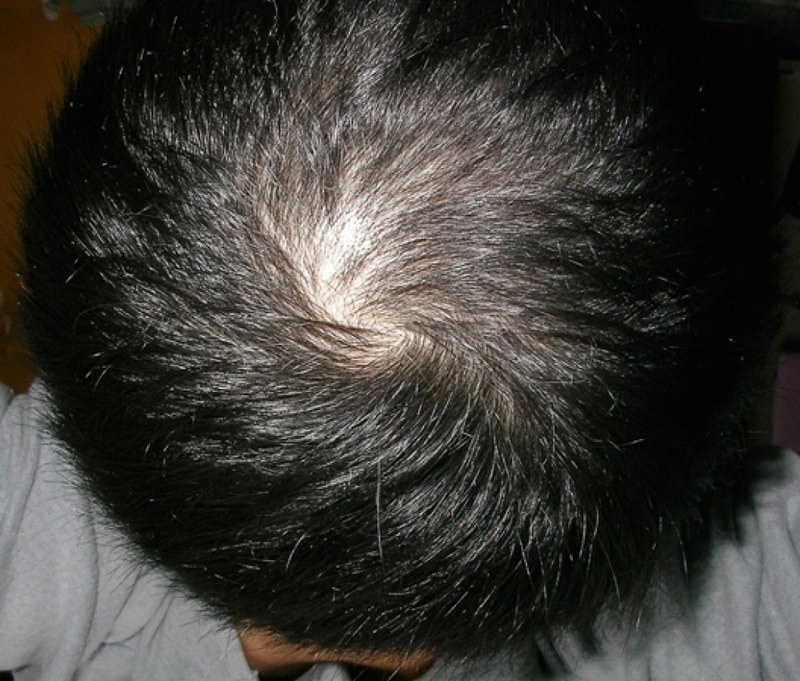 피나테드 11개월째 후기