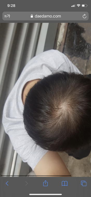 프로스카 먹기 시작했을때