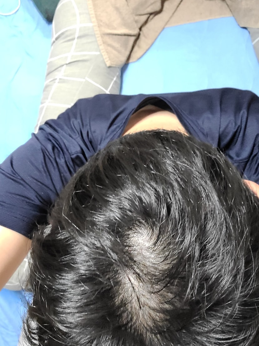 복용 한달차입니다. 쉐딩 왔는지 엄청 털렸었네요