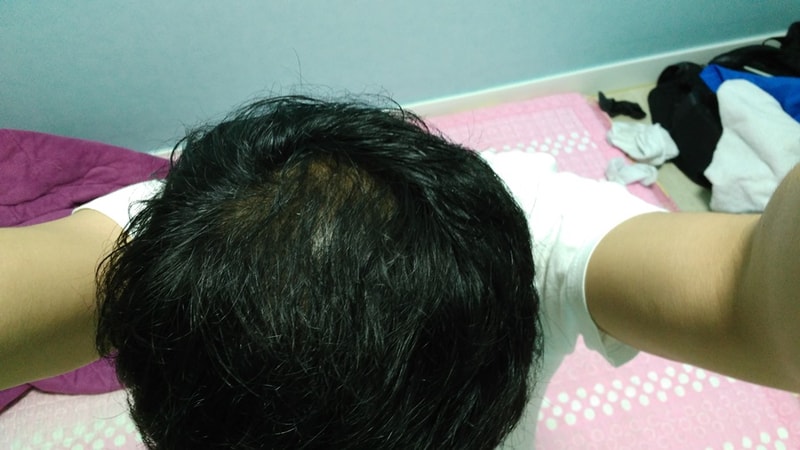 是流血或服用2个月的照片。