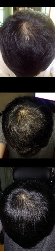 这是服用5个月的Propecia的后记。