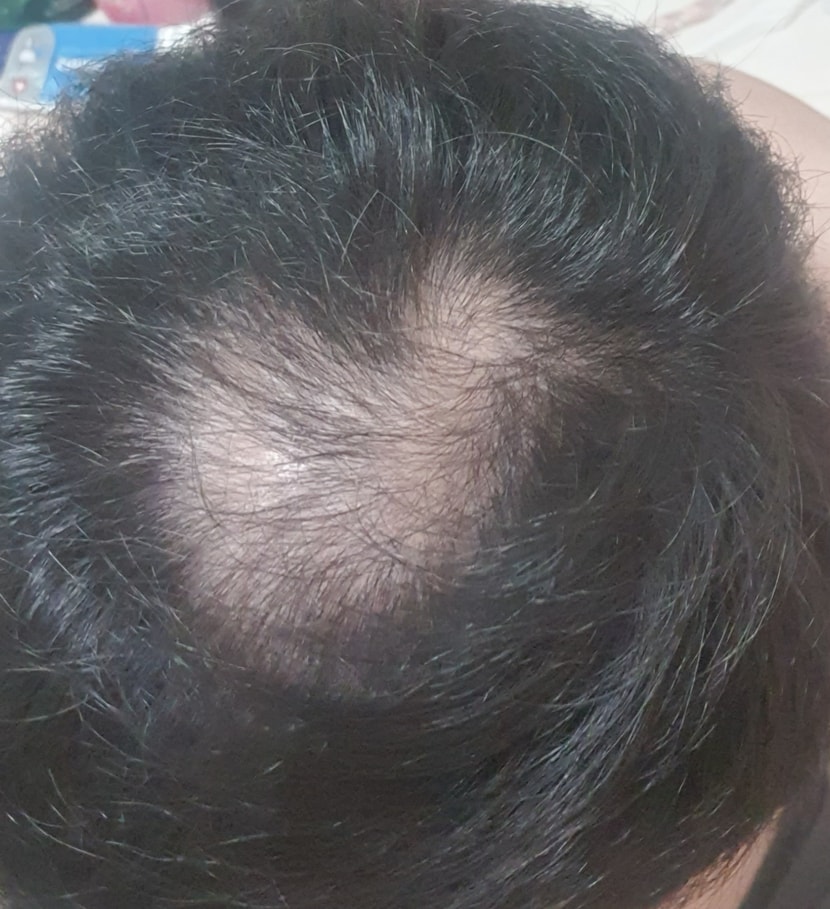 피나 먹기전