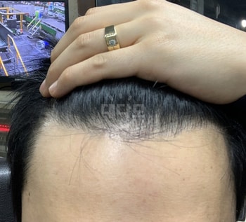 수술후 3년