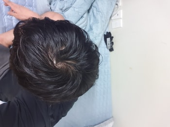 미녹시딜 바르고나서 머리가굵어짐