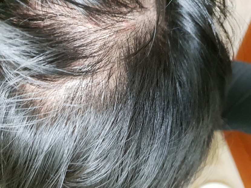 6개월전 절망적인 머리숱