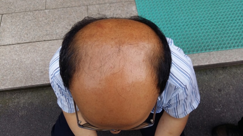 2015년 7월 22일  약 먹기 2주일 전