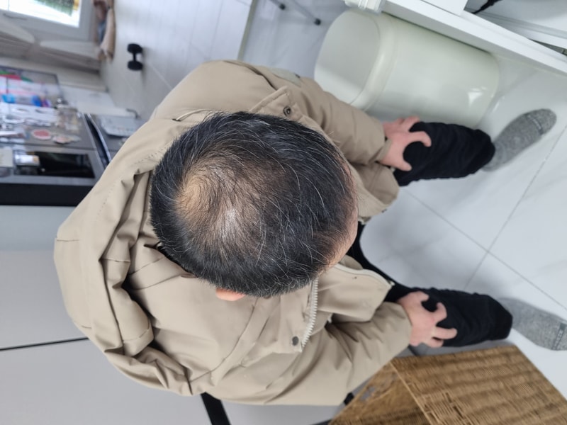 탈모약 시작합니다.