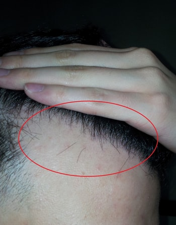 M자쪽 솜털이 보이는데 이게 머리가 나는건지 궁금한 사진